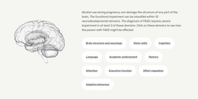 Brain impairment in FASD